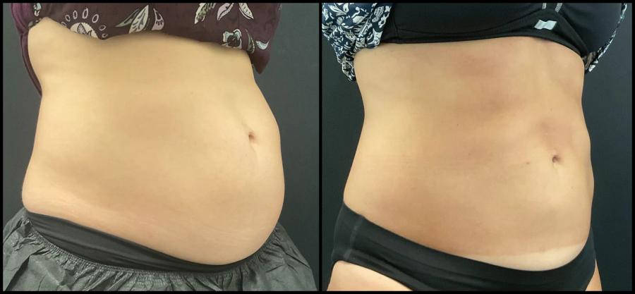 Avant et après CoolSculpting — taille et hanches redessinées. — Oblique droite