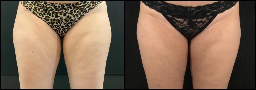 Avant et après CoolSculpting — galbe externe des cuisses lissé.