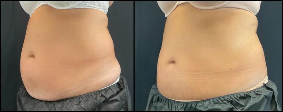 Avant et après CoolSculpting — abdomen visiblement aplani, vue oblique. — Oblique gauche