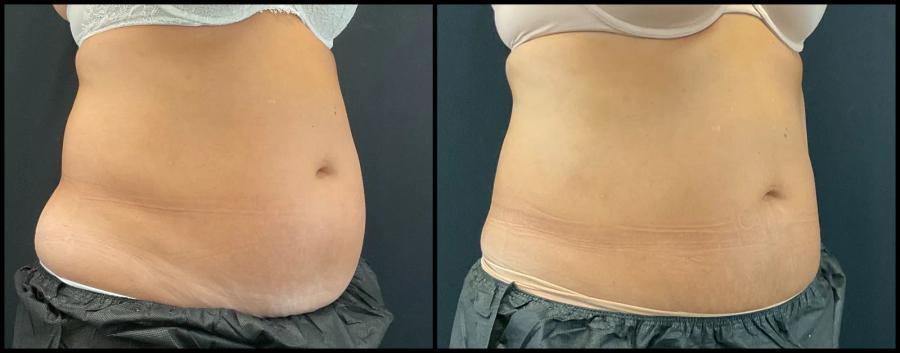 Avant et après CoolSculpting — abdomen visiblement aplani, vue oblique.