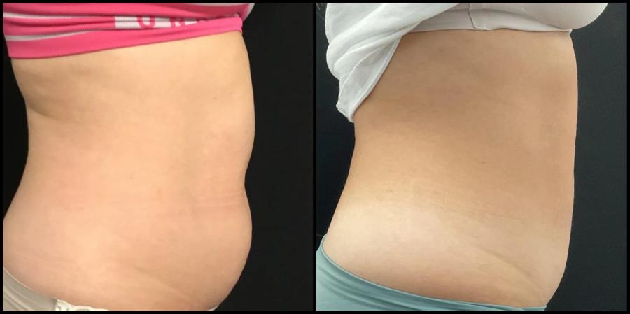 Avant et après CoolSculpting — projection abdominale réduite, vue de profil.