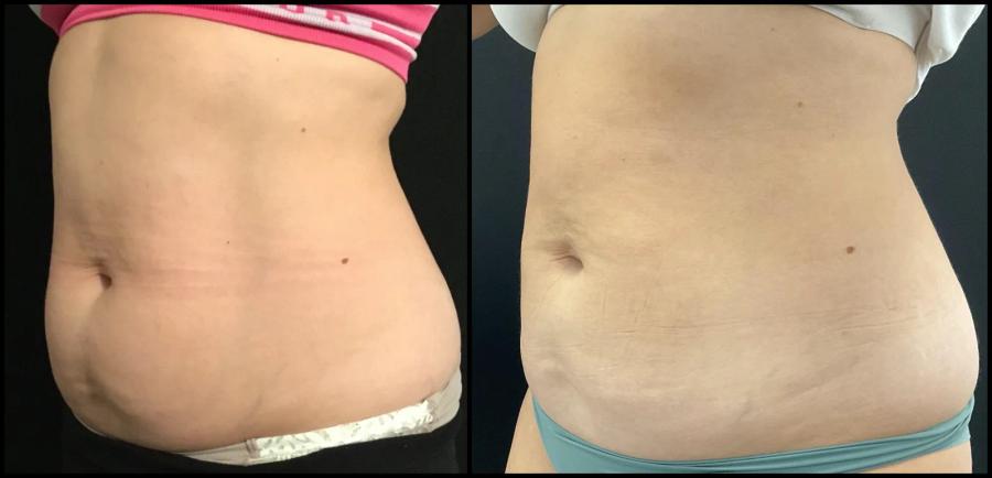 Avant et après CoolSculpting — projection abdominale réduite, vue de profil. — Oblique gauche