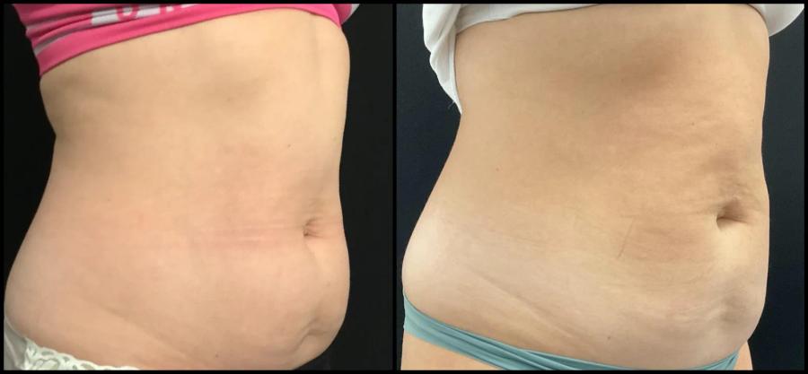 Avant et après CoolSculpting — projection abdominale réduite, vue de profil. — Oblique droite