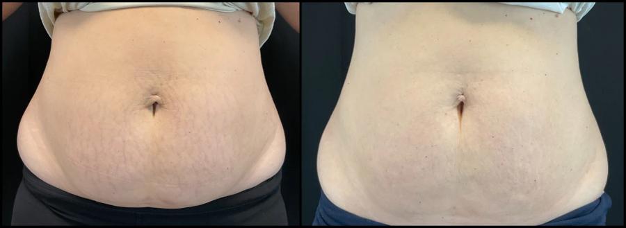 Avant et après Morpheus8 sur le corps — peau de l’abdomen plus ferme et lisse.