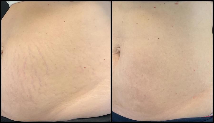 Avant et après Morpheus8 sur le corps — peau de l’abdomen plus ferme et lisse. — Oblique gauche