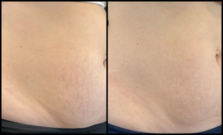 Avant et après Morpheus8 sur le corps — peau de l’abdomen plus ferme et lisse. — Oblique droite