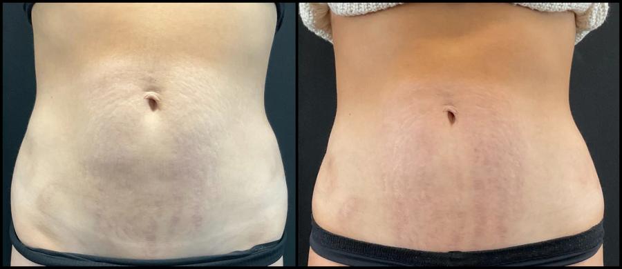 Avant et après Morpheus8 sur le corps — peau abdominale resserrée et plus uniforme.