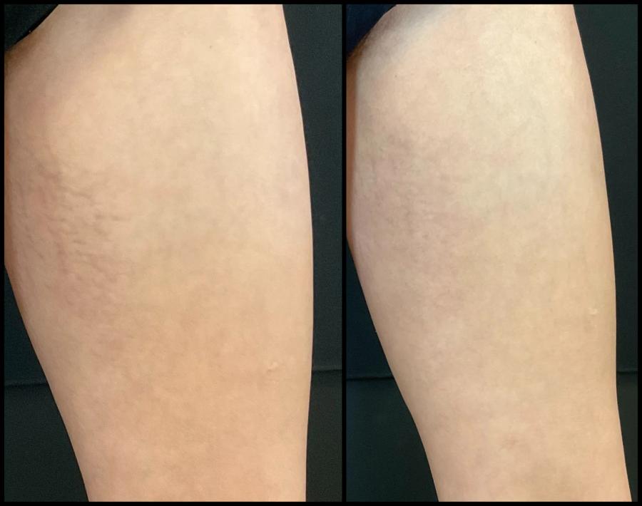 Avant et après Morpheus8 sur le corps — peau abdominale resserrée et plus uniforme. — Cuisse interne
