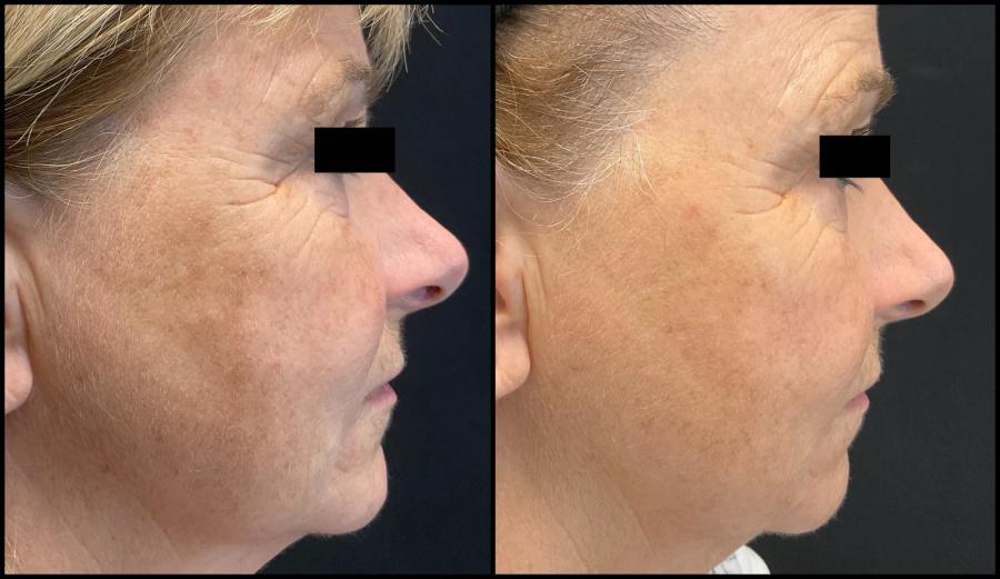 Avant et après Morpheus8 — texture de profil affinée et teint ravivé.