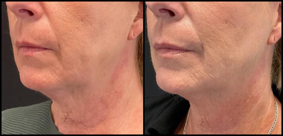 Avant et après Morpheus8 — peau du cou plus lisse et ovale mieux défini. — Oblique gauche