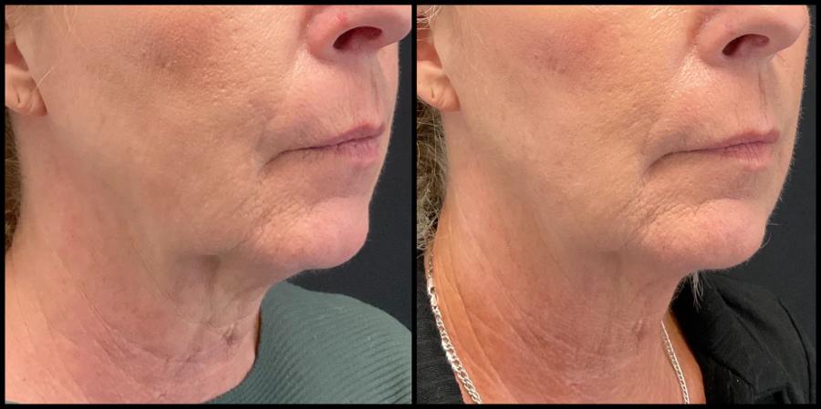 Avant et après Morpheus8 — peau du cou plus lisse et ovale mieux défini.