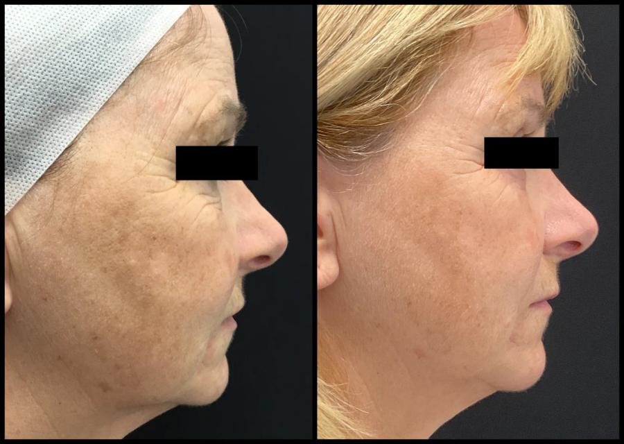 Avant et après Morpheus8 — texture de la joue plus lisse et teint plus uniforme. — Profil droit
