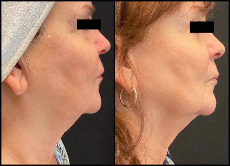 Avant et après Morpheus8 — bas du visage et cou raffermis, contour plus défini. — Profil
