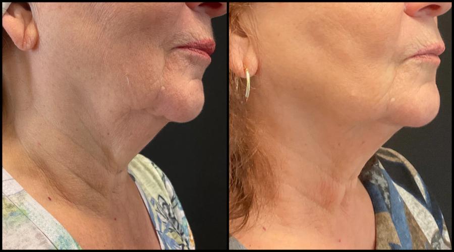 Avant et après Morpheus8 — bas du visage et cou raffermis, contour plus défini. — Oblique droite
