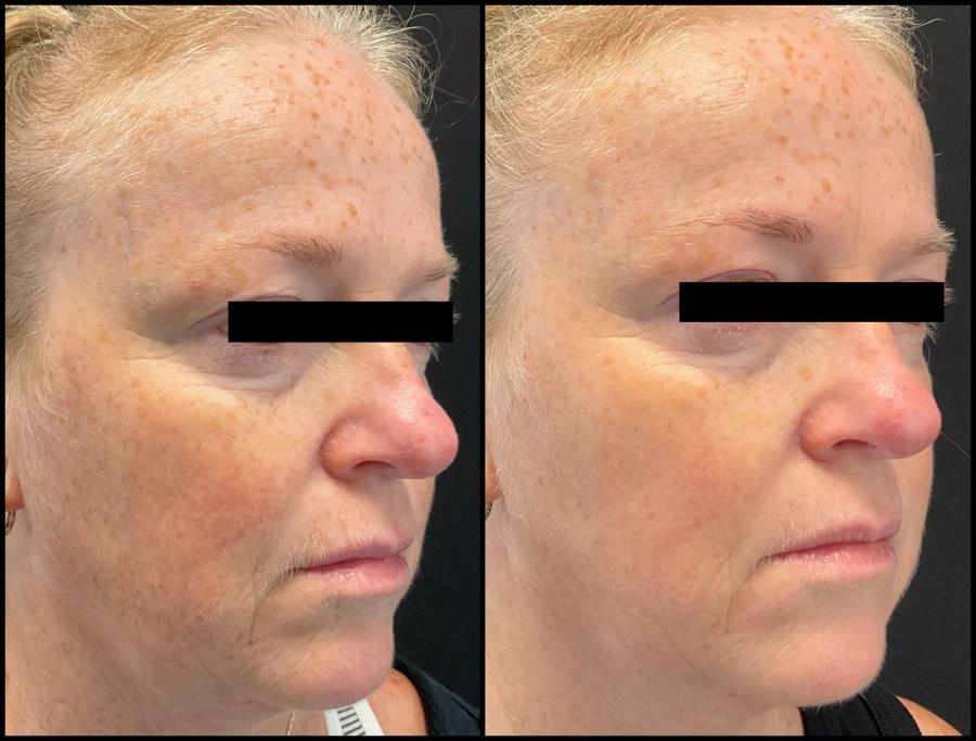 Avant et après Morpheus8 — contour de l’œil défroissé et joue plus lisse.