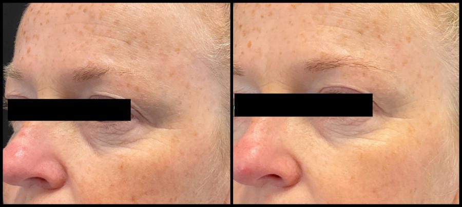 Avant et après Morpheus8 — contour de l’œil défroissé et joue plus lisse. — Haut du visage
