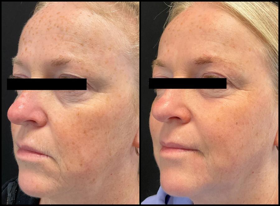 Avant et après Morpheus8 + laser CO2 — teint plus uniforme, taches atténuées et texture lissée. — Oblique gauche