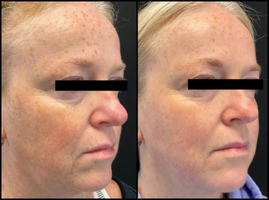 Avant et après Morpheus8 + laser CO2 — teint plus uniforme, taches atténuées et texture lissée.