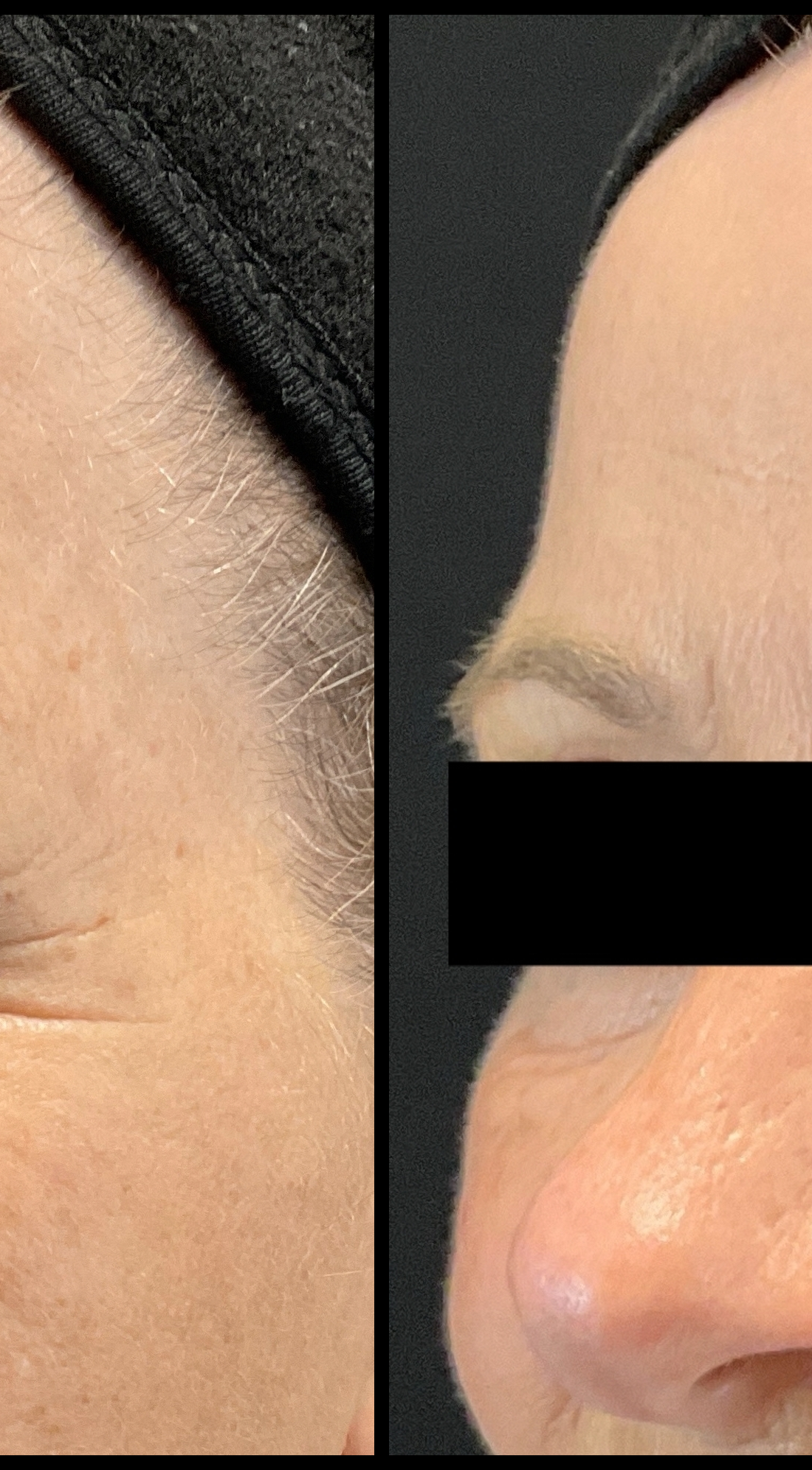 Avant et Après Rides & Texture — Vue de Face — Joanne J.
