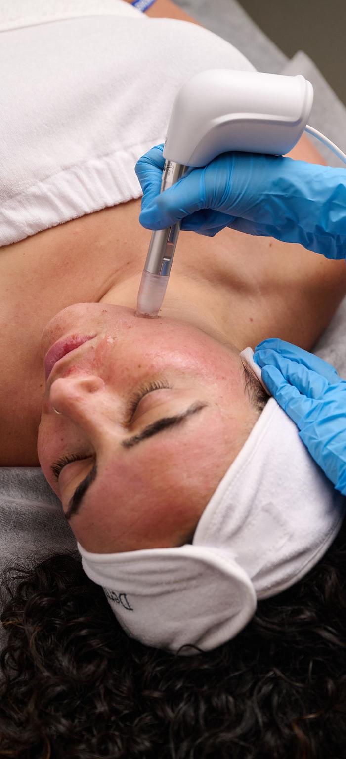 Microneedling à Bois-des-Filion