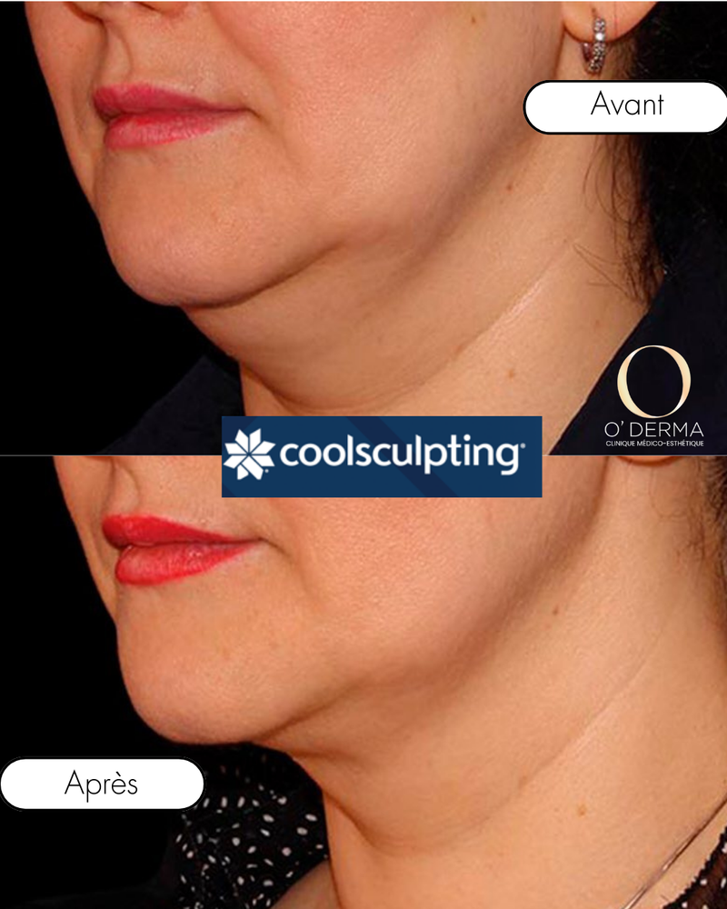 CoolSculpting
