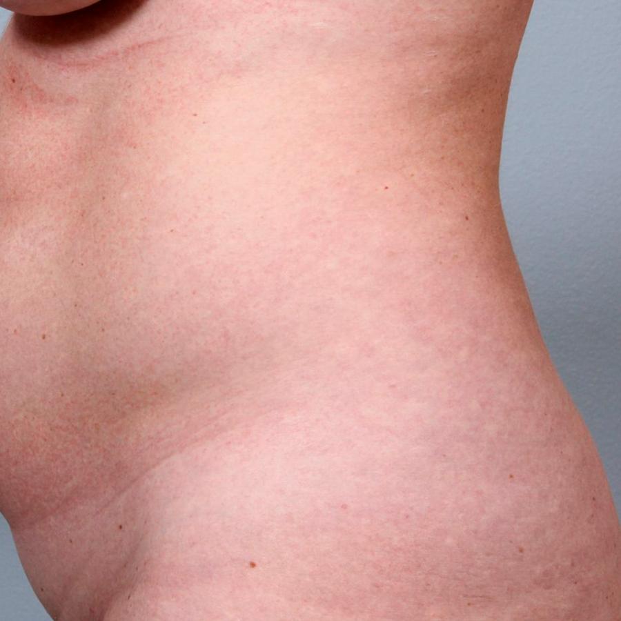 Avant et après BodyFX du tronc — amélioration de la fermeté de la peau.