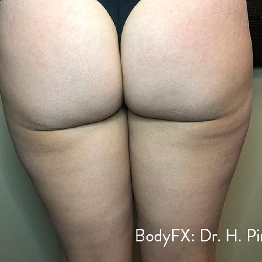 Avant et après BodyFX — amélioration de la texture de la peau et de la cellulite.