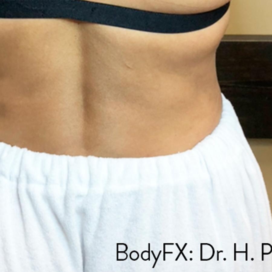Avant et après BodyFX de l’abdomen — silhouette plus tonique.
