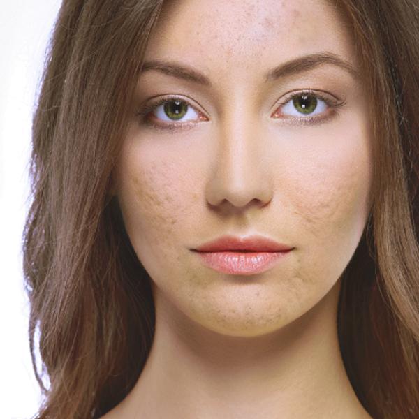 Mélasma : comprendre et traiter le masque de grossesse