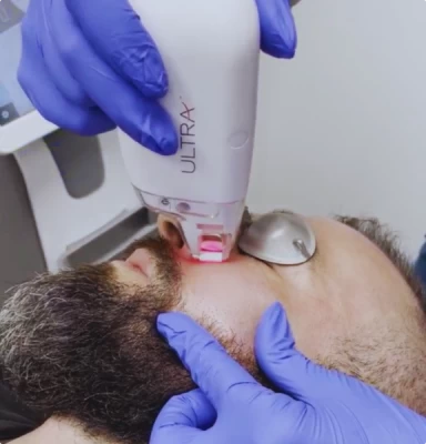Séance de resurfaçage cutané au laser sur le visage en clinique O'Derma