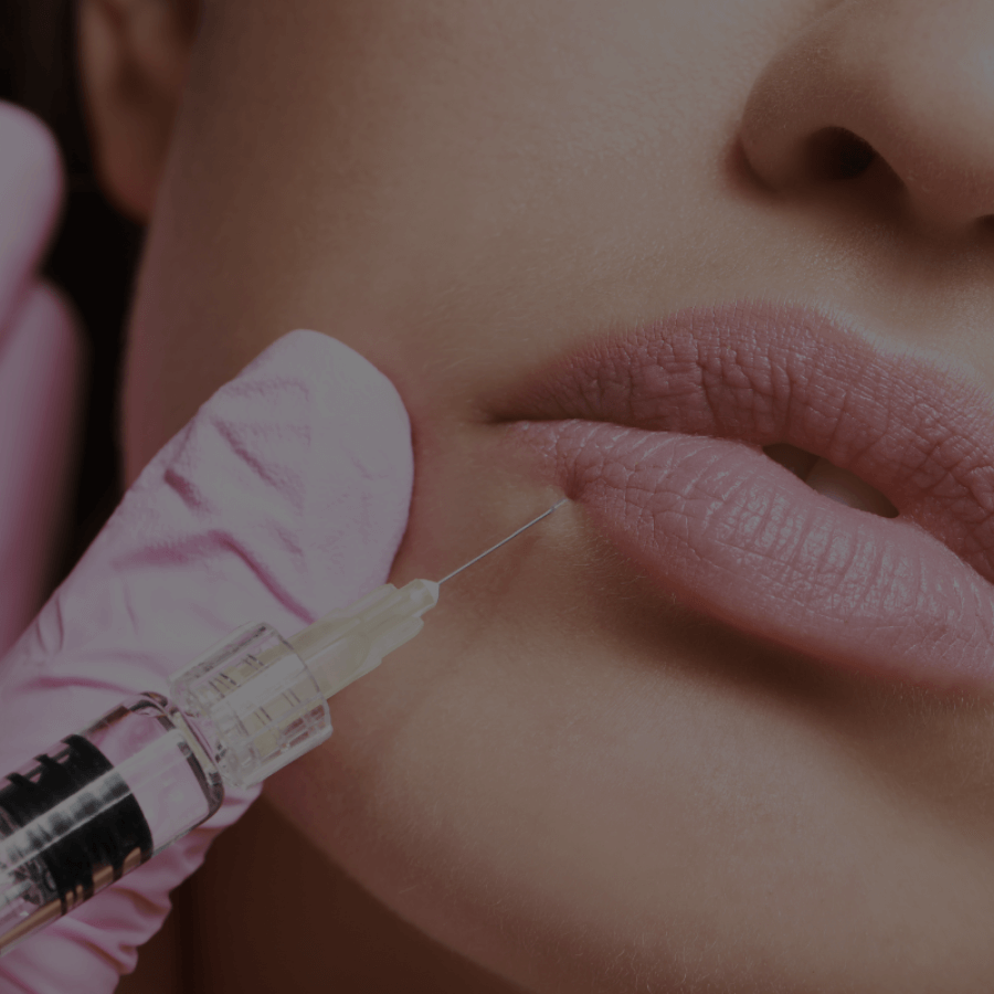 Consultation agents de comblement — Médecin injecteur O'Derma