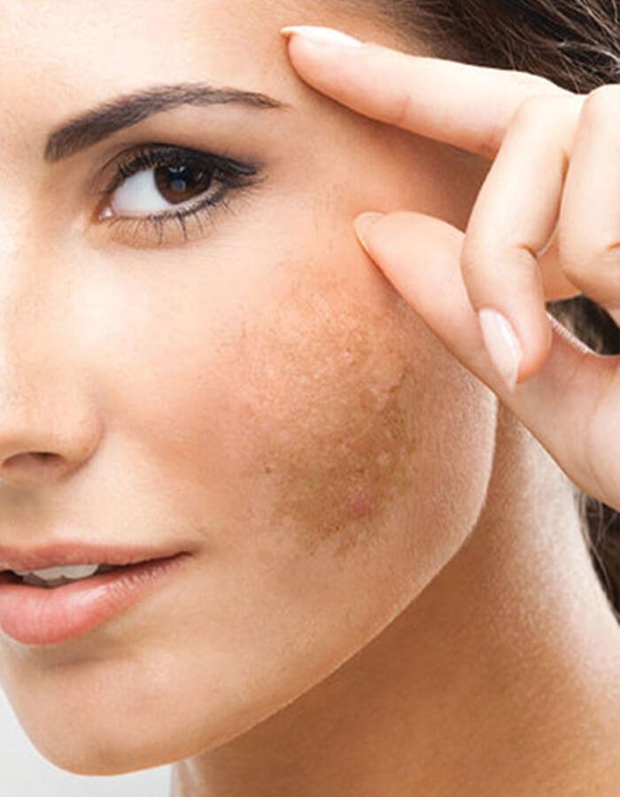 Taches & Pigmentation